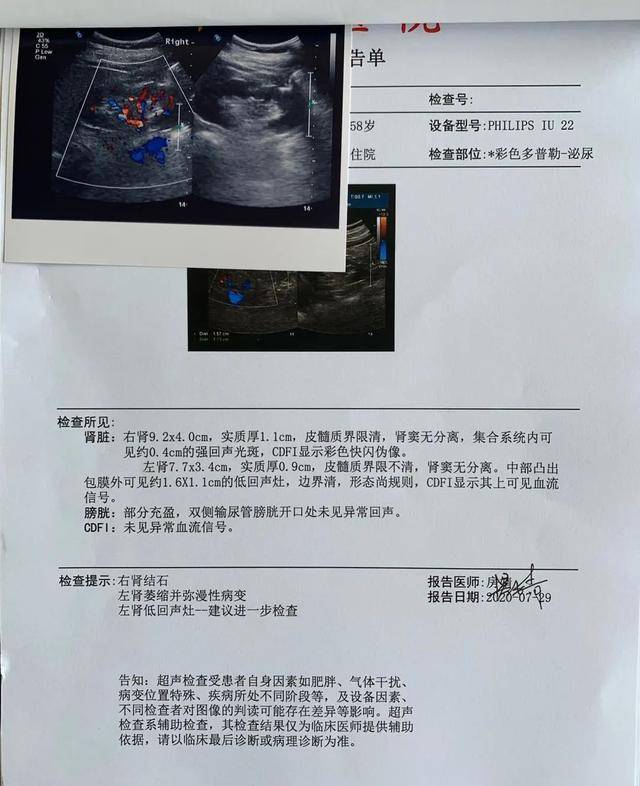 肾脏|直到肾衰了才被发现，这种肾病其实很常见