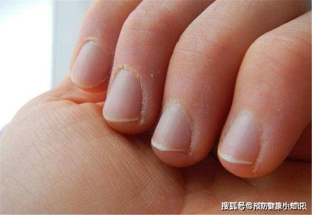 代谢|肝好的人，手上会有5个“标志”，占了一个，都要恭喜你！