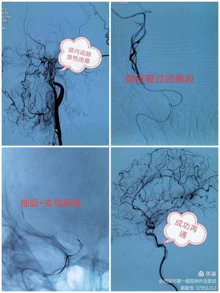 头颅|【医院动态】西安一院神外血管组介入病例系列15——7月“拆弹”“修路”记