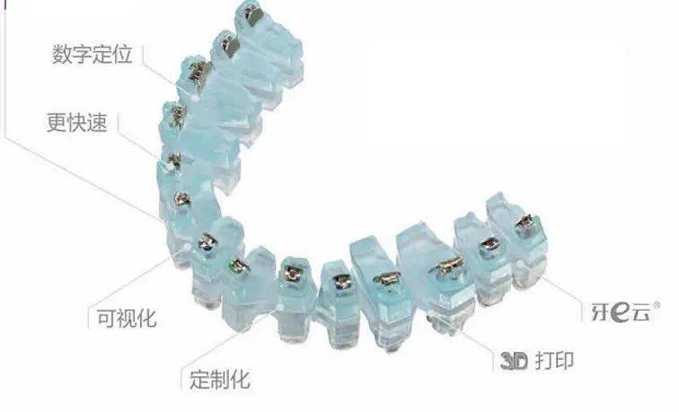 汕头|固定矫正也能看3D效果，数字化正畸导航系统了解一下