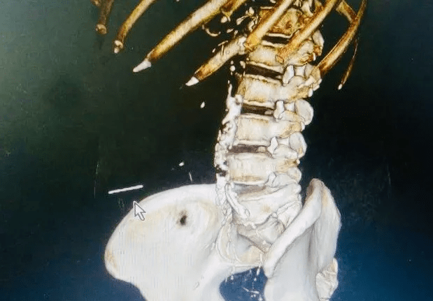 针刺|阿婆自行针灸,不料针断腹中!医生紧急提醒