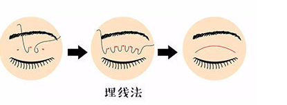 艾美|割完双眼皮，漂亮1000倍？盲从，往往不尽人意！达芬奇定制美眼竟被称整形模板