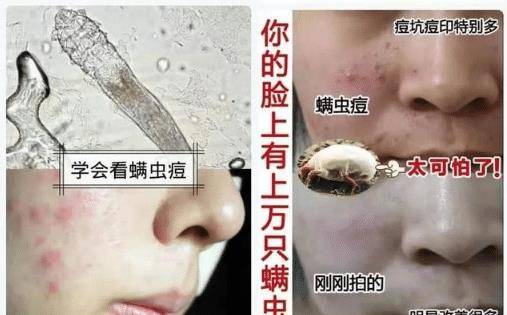 长痘痘|脸上露出4个丑态，说明螨虫正在“做窝打洞”，教你3招除螨、净痘