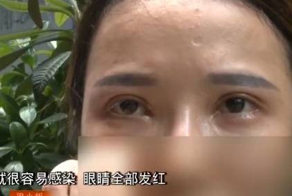 眼睛|21岁女子割双眼皮开眼角后，眼睛红痛视力模糊，医院：眼角膜脱落