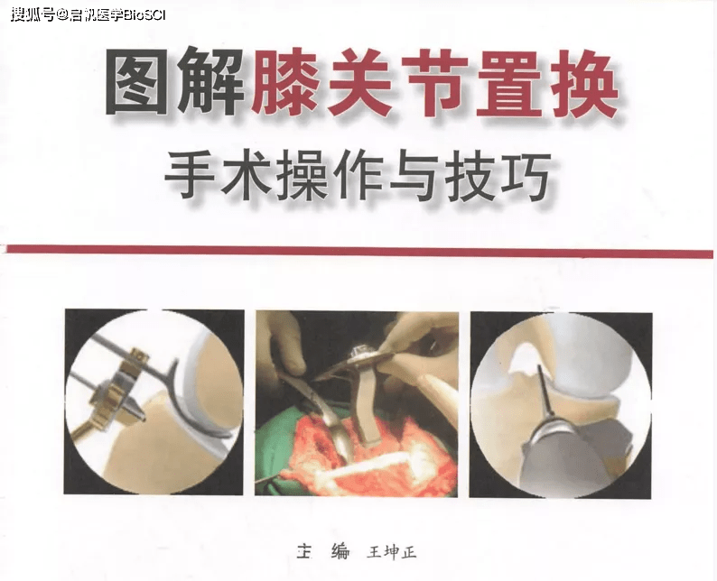 資料| 圖解膝關節置換手術操作與技巧,適合各級骨科關節外科醫生