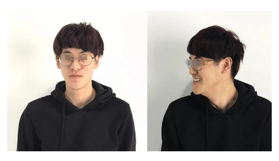 龅牙|广东省全民爱牙行动 地包天需要正畸正颌联合治疗