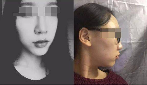 龅牙|广东省全民爱牙行动 地包天需要正畸正颌联合治疗