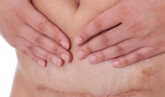 进行|剖腹产横切和竖切,原来是有区别的,想要二胎的宝妈要慎重选择!