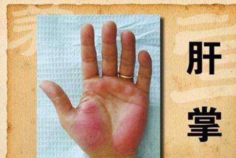 什么|误认为皮肤过敏,结果查出肝癌!提醒:皮肤4种异常或是肝癌前兆