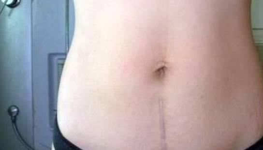 进行|剖腹产横切和竖切,原来是有区别的,想要二胎的宝妈要慎重选择!