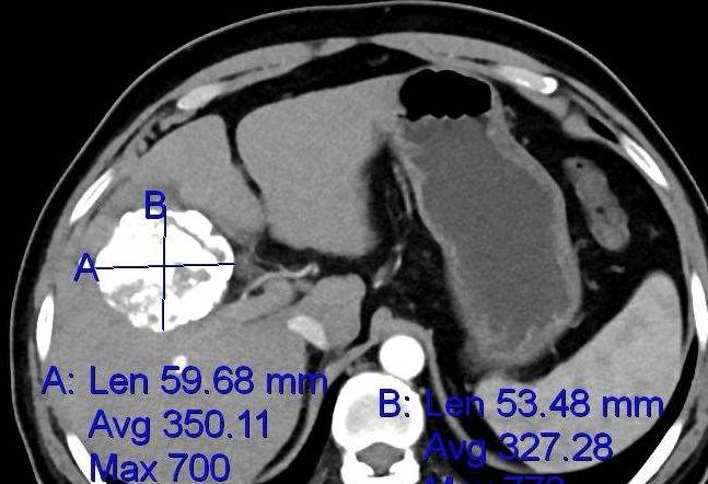 什么|误认为皮肤过敏,结果查出肝癌!提醒:皮肤4种异常或是肝癌前兆