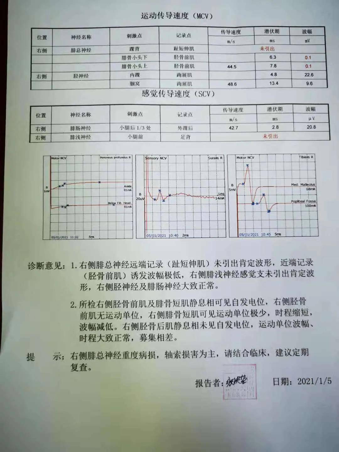 运动|康复治疗︱让腓总神经损伤患者恢复运动功能