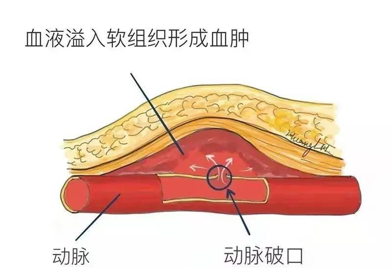 我院順利完成一例急症動脈瘤介入栓塞手術三博腦科醫院 林志雄·2021