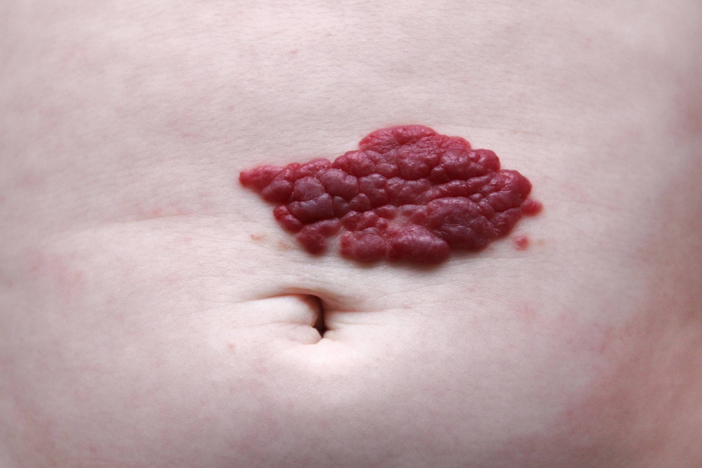 红色素血管瘤图片图片