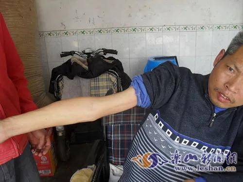 症状|简单认识下运动神经元性瘫痪——渐冻症