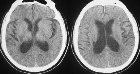 14岁孩子查出脑萎缩,只因爱吃2种早餐_大脑
