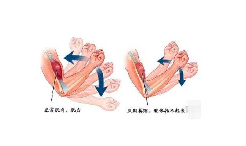 疑难|我国肌营养不良症，高发群、高地区、看看你是否身陷其境！