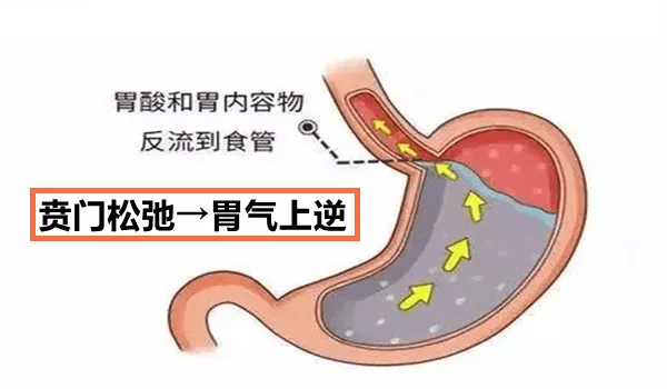 還有胃燒疼的情況,四聯療法之後,病菌被滅殺了,所以