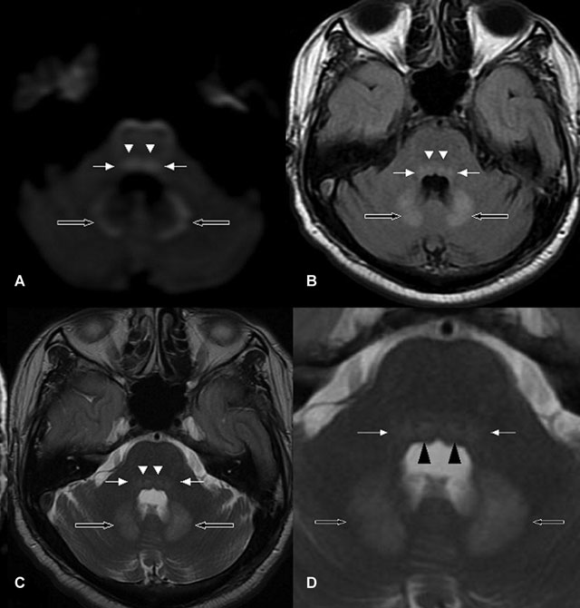 颅脑mri示:双侧小脑齿状核(空箭头,前庭神经核(白色箭头,展神经核
