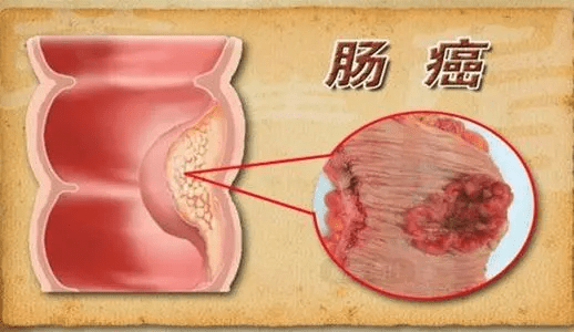 长了结肠息肉,会有什么症状?看完你就有数了