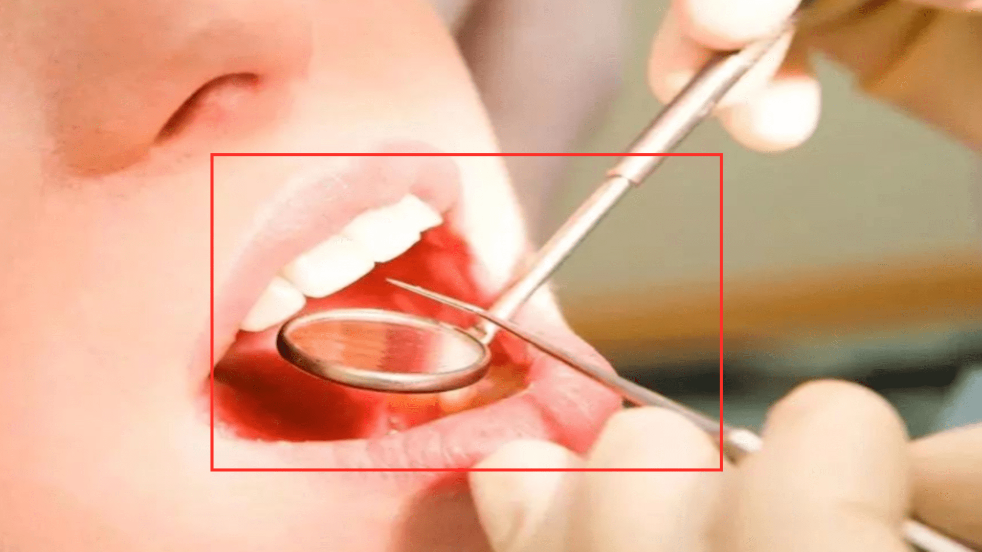 检查|男人30岁出头牙齿几乎掉光？医生提醒，这个病很多人都有