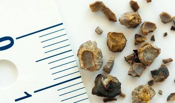 治疗|肾结石多喝水可以排出来？了解这些事，再做决定也不迟