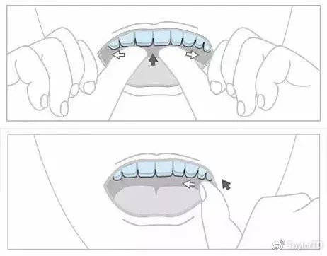牙膏|戴隐形牙套！这几件事，很重要！深圳善贝口腔科普