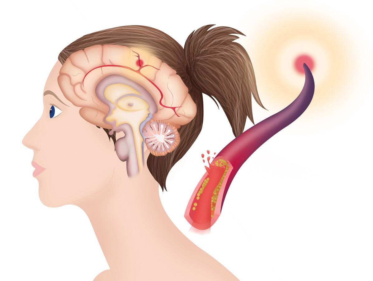 治疗|腔隙性脑梗塞要不要吃药?需要看病因,避免过度治疗