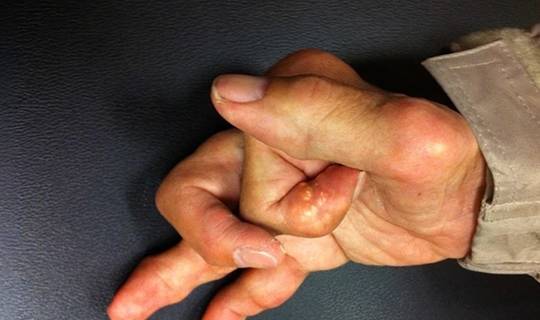 肾脏|这4种疾病看似和肾没关系，却在悄悄地伤肾！