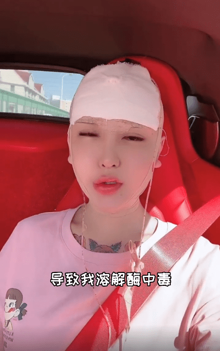因为|女网红注射奥美定8年后爆发问题，额头内部溃烂，透露胸和屁股都曾注射奥美定