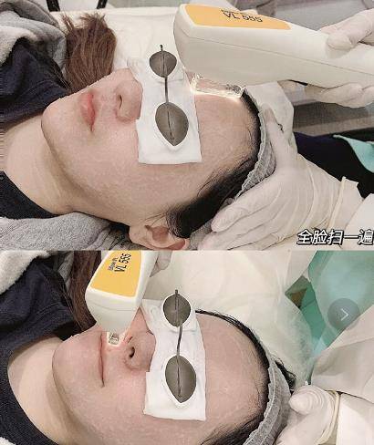 因为|超光子嫩肤去红血丝是一种什么体验?