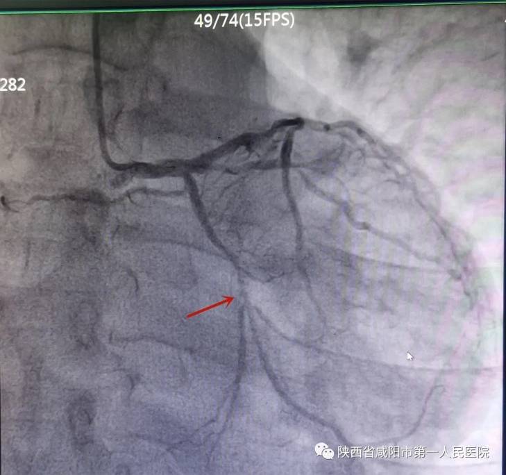 冠脉|咸阳市第一人民医院：多科室密切协同，成功完成一例二尖瓣成形+冠脉搭桥术