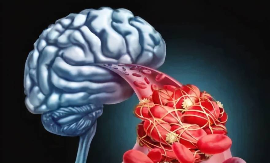 症状|腔隙性脑梗死很严重吗？是不是马上要瘫痪了？