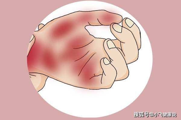 严重|肝病一查出来就是晚期？医生：好多人忽视了手腿的提示，拖严重了