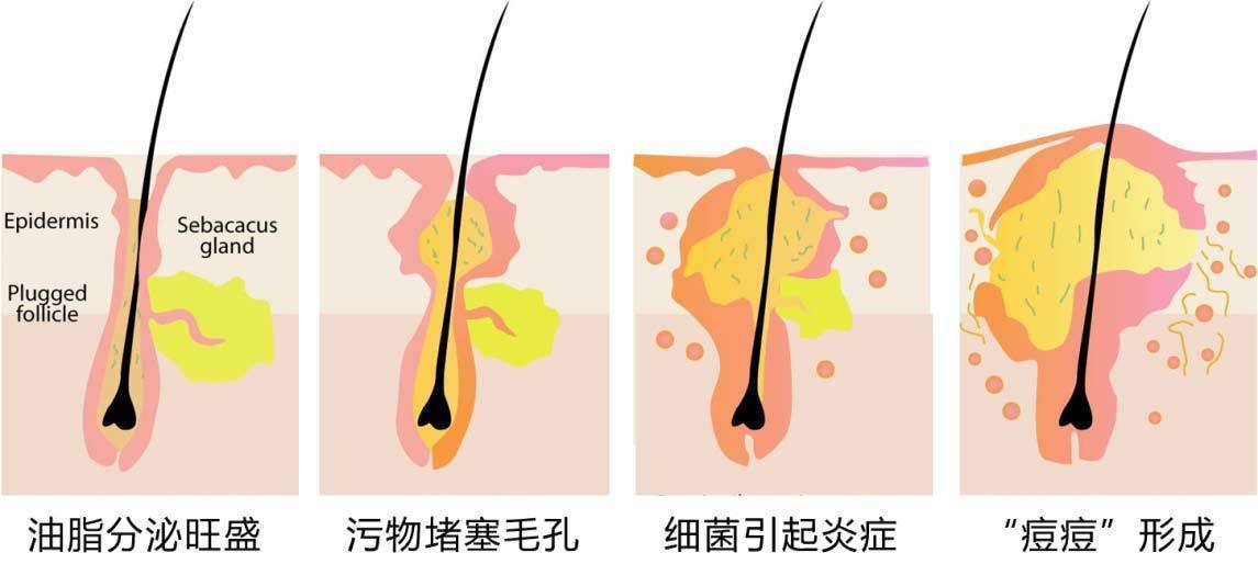 成份|换季痘肌能用美容油吗？