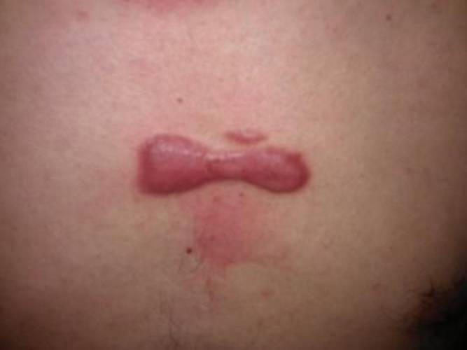 什么是增生性疤痕 6759a822ab964323910acb94d92198b6.jpeg