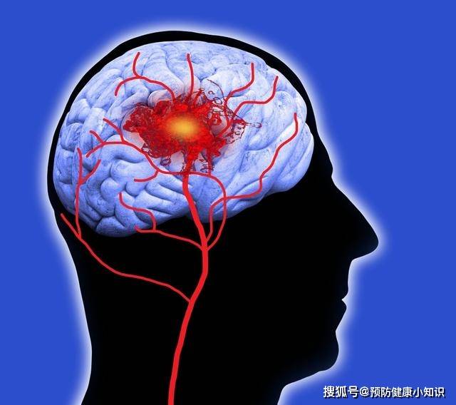 是什么原因引起的脑梗 8a6a1015eb4940f685eeb4decaeb46bf.jpeg