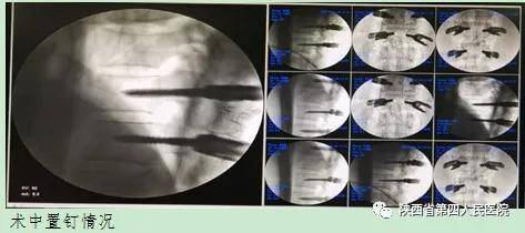 管理|陕西省第四人民医院精准围术期管理 多学科合作让高处坠落多发伤患者重新站起