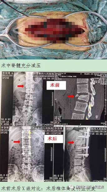 管理|陕西省第四人民医院精准围术期管理 多学科合作让高处坠落多发伤患者重新站起
