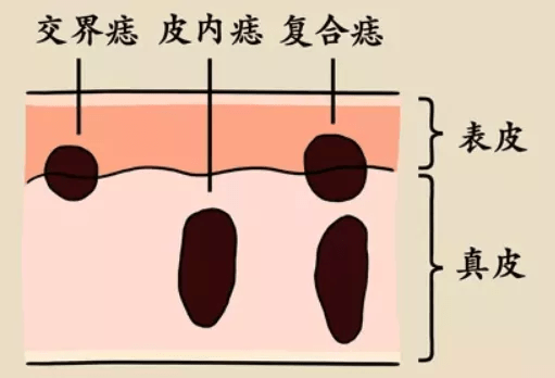 长在身体这4个部位的痣可能与癌症密切相关