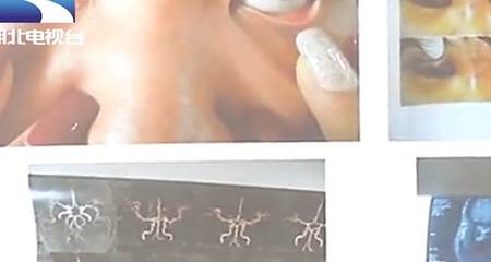 都属|打玻尿酸隆鼻，反把眼睛“弄瞎”