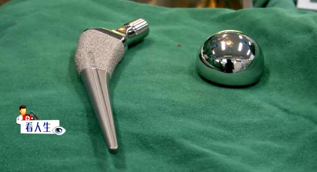 老人|股骨颈骨折、骨质疏松！101岁高龄老人意外摔倒，做了这个手术后...