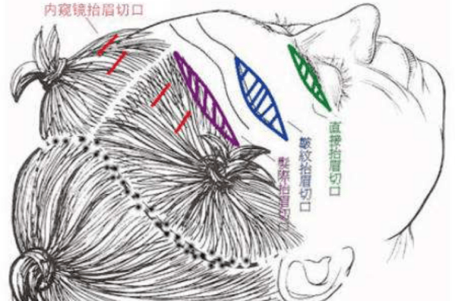 三个阶段|实话说：拉皮手术有什么副作用吗？