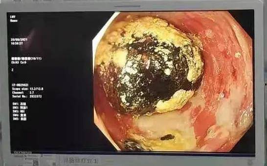 大肠|丨消化道卫士丨肠镜日记：当粪石遇到我…