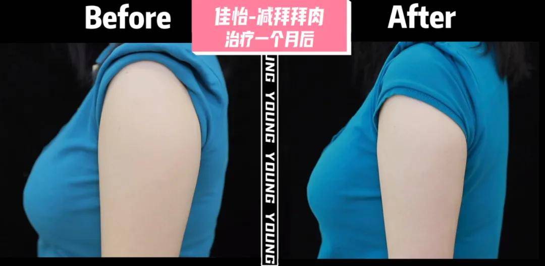 效果|孔雪儿怎么肿成这样？这是填充失败了吗？！