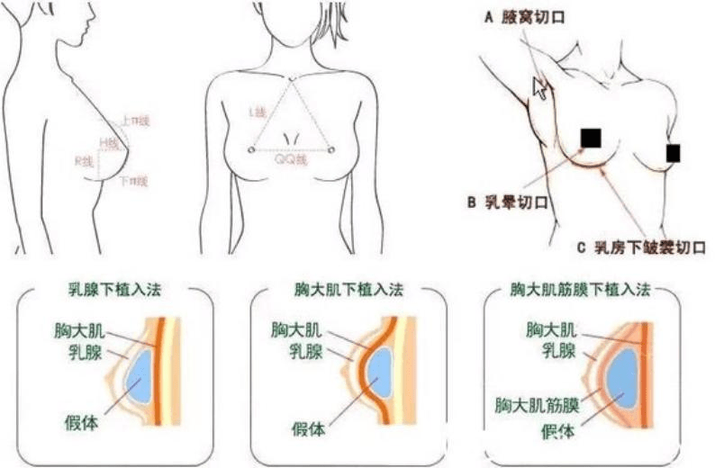 怎样做丰胸手术（丰胸手术怎么做）