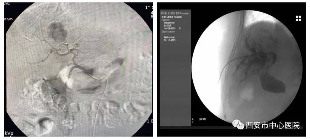团队|西安市中心医院消化病院介入团队成功完成TIPSS手术