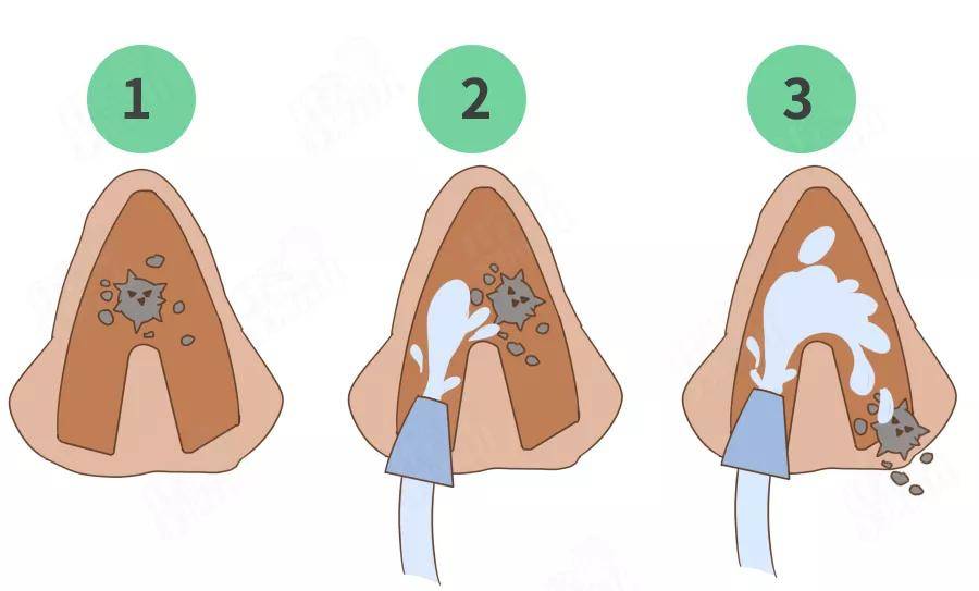 来源|过敏性鼻炎正高发：路边常见的一种草，可能是头号过敏原！
