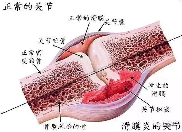吃什么药可以消除膝关节积液 163999e8020b49a89789090b93a42bf0.jpeg