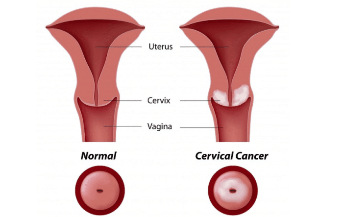 宫颈癌哪个部位会疼图片